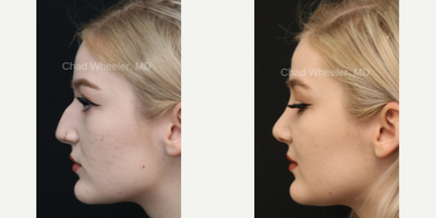 Rhinoplasty before and after photo