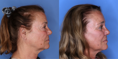 Brow Lift before and after photo
