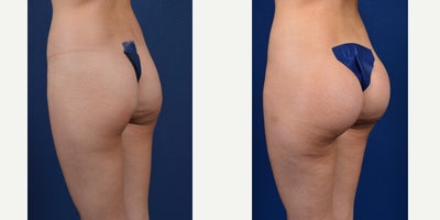 Butt Augmentation before and after photo