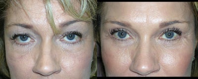 Facelift before and after photo