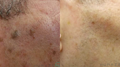 Laser Resurfacing before and after photo
