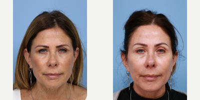Deep Plane Facelift before and after photo