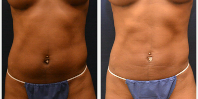 Liposuction before and after photo
