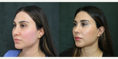 Revision Rhinoplasty before and after photo