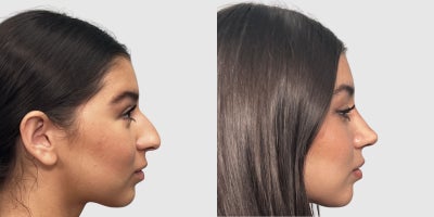 Rhinoplasty before and after photo