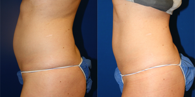 SculpSure before and after photo