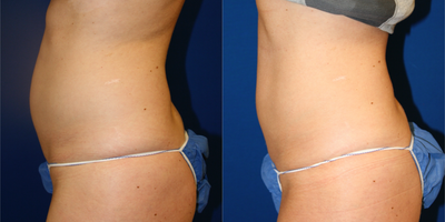 SculpSure before and after photo