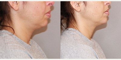 Chin Filler before and after photo