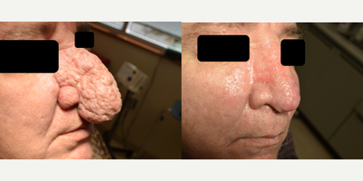 CO2 Laser before and after photo