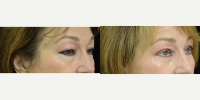 Eyelid Surgery before and after photo