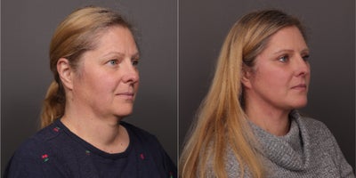 Facelift before and after photo