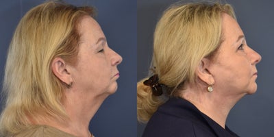 Facelift before and after photo