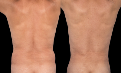 Liposuction before and after photo