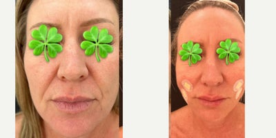 Nonsurgical Facelift before and after photo