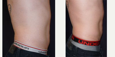 SculpSure before and after photo