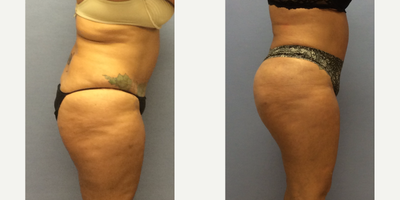 Brazilian Butt Lift before and after photo