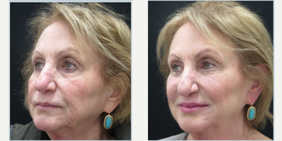 Cheek Fillers before and after photo