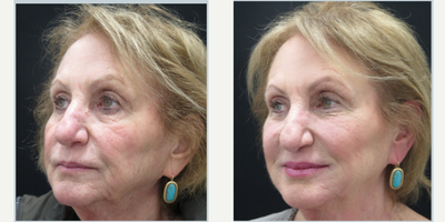 Cheek Fillers before and after photo