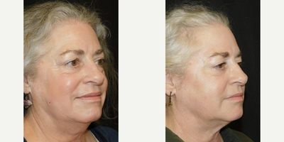 CoolSculpting before and after photo