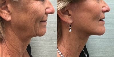 Deep Plane Facelift before and after photo