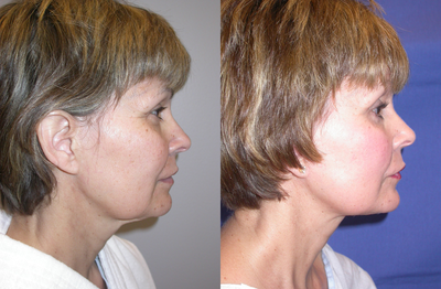 Facelift before and after photo