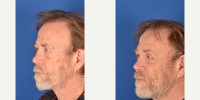 Brow Lift before and after photo