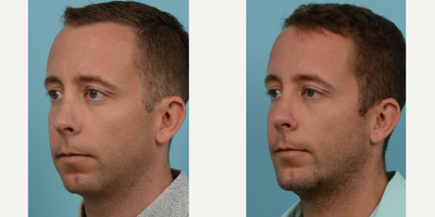 Chin Implant before and after photo