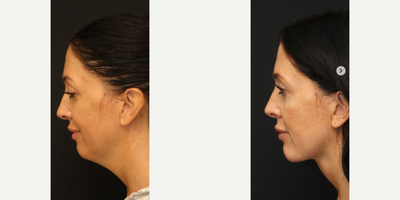 Chin Implant before and after photo