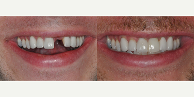 Dental Implants before and after photo