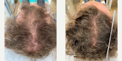 Hair Loss Treatment before and after photo