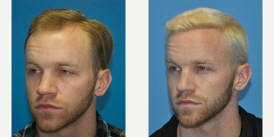 Hair Transplant before and after photo