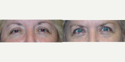 Ptosis Surgery before and after photo