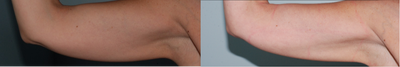 CoolSculpting before and after photo