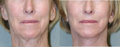 Facelift before and after photo