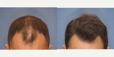 Hair Transplant before and after photo