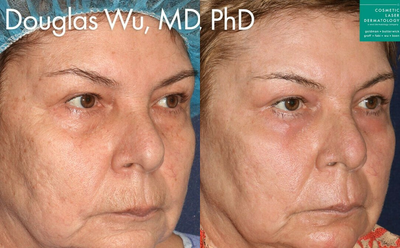 Laser Resurfacing before and after photo