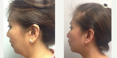 PrecisionTx before and after photo