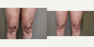 Smart Lipo before and after photo