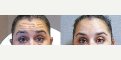 Botox before and after photo