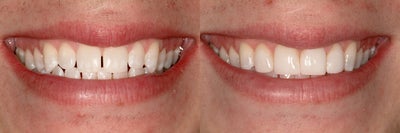 Dental Bonding before and after photo