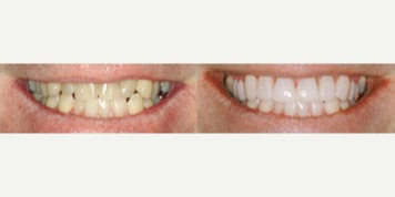 Porcelain Veneers before and after photo