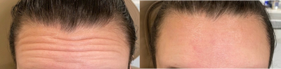 Botox before and after photo