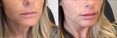 Lip Fillers before and after photo
