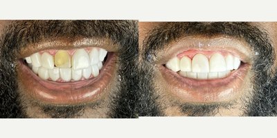 Porcelain Veneers before and after photo