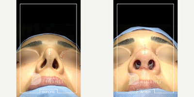 Revision Rhinoplasty before and after photo