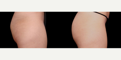 Skin Tightening before and after photo