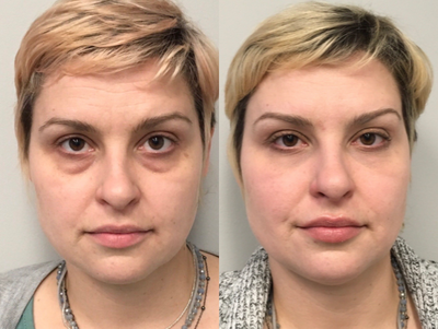 Eyelid Surgery before and after photo