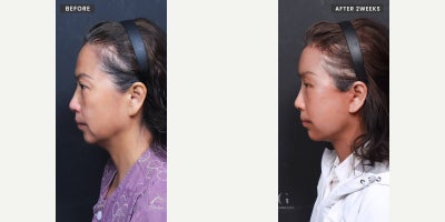 Eyelid Surgery before and after photo