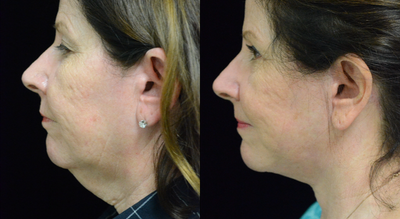 Genioplasty before and after photo