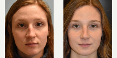 Rhinoplasty before and after photo